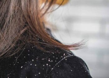 Is Dandruff Contagious? Separating Facts from Fiction for Scalp Health