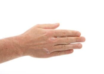 is psoriasis truly contagious