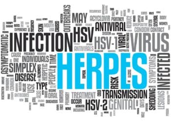 Can you get herpes from kissing