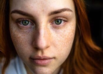 Does Makeup Cause Acne? 5 Interesting Facts To Know