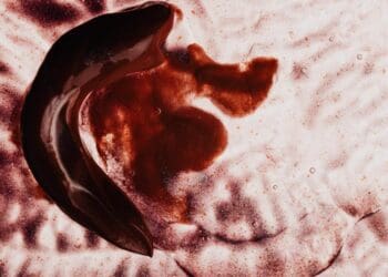 What causes ear bleeding?