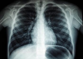 What Does a Chest X-Ray Show About Your Heart