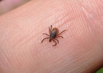 13 Effective Home Remedies that Will Kill Lice