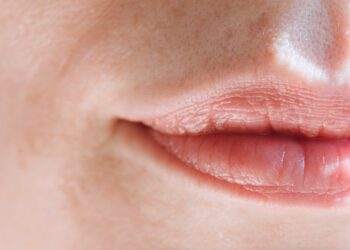 How to Get Rid of Red Rings Around Lips