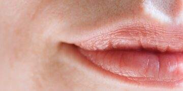 How to Get Rid of Red Rings Around Lips